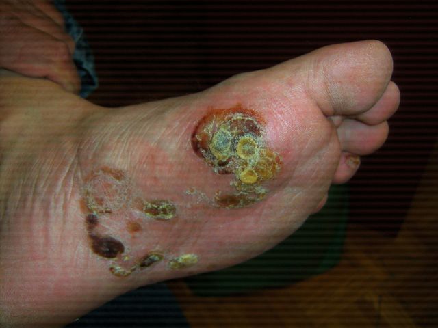 foot fungus blisters #11