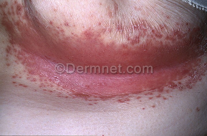 rash in skin folds #11