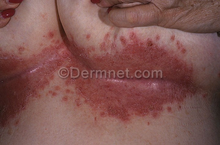 can a fungal infection cause eczema
