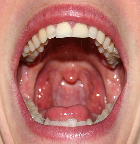 Mouthwash For Oral Thrush 96