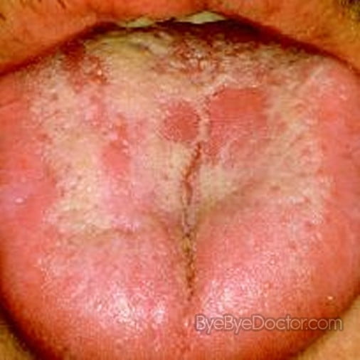 Is thrush of the mouth contagious?