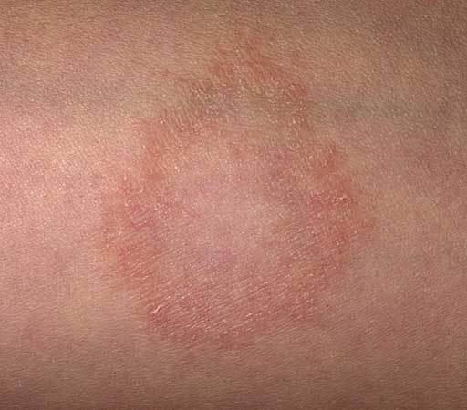 Dry Patch Of Skin On Upper Leg