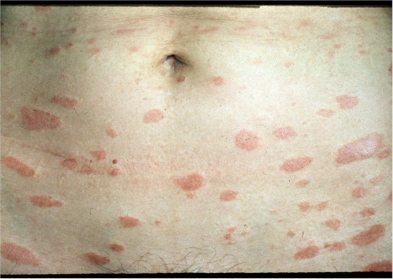 rashes in skin folds