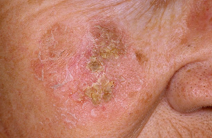 Hardin MD : Dermatology Pictures / Skin Disease Pictures