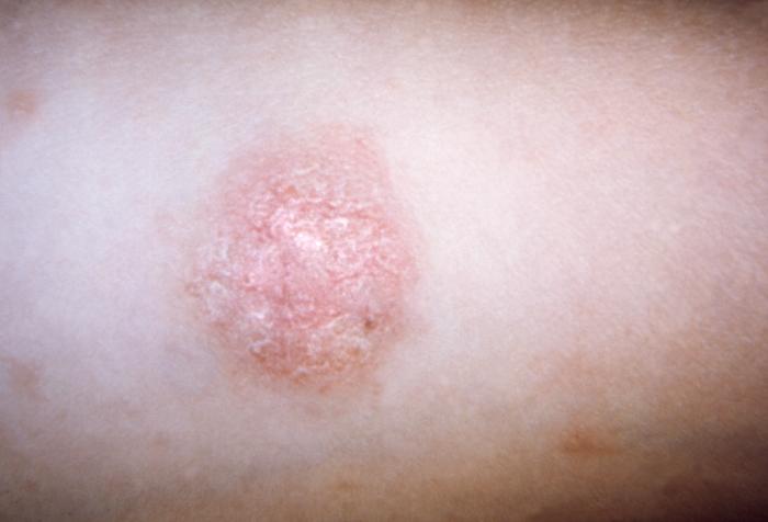 White Patch Skin Disease